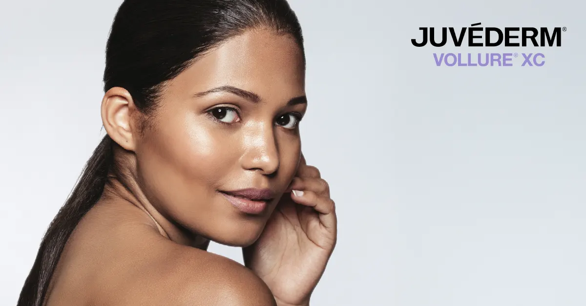 Juvederm Vollure for laugh lines