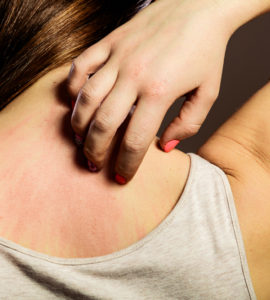 summer skin problems